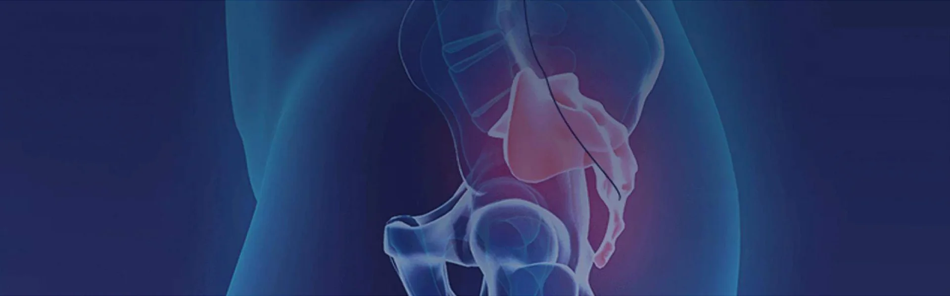Sacral Nerve Stimulation